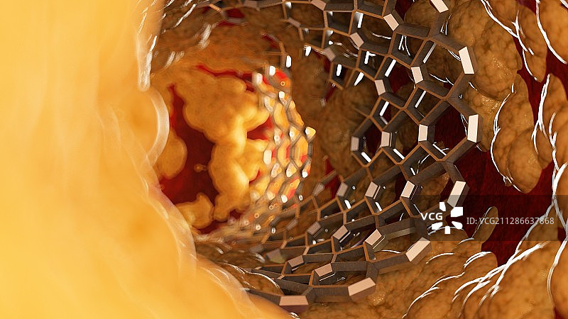 脂肪动脉内支架插画图片素材