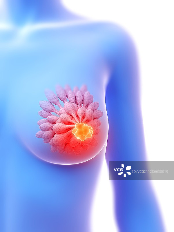 乳腺肿瘤插图图片素材