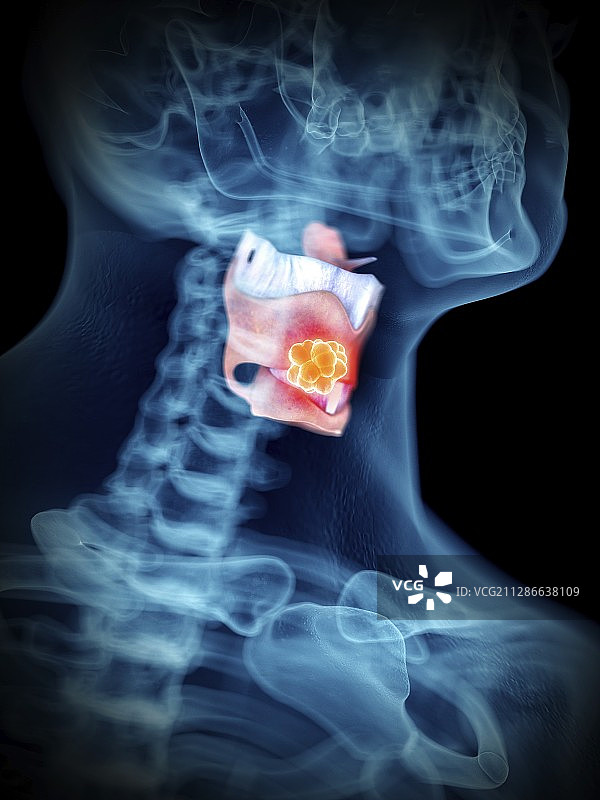 男人的喉肿瘤插画图片素材