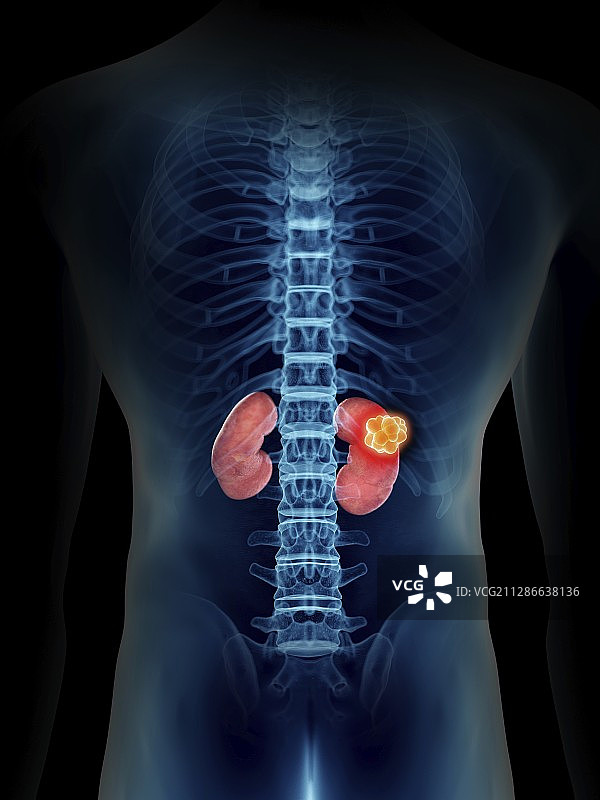 男人的肾脏肿瘤插图图片素材