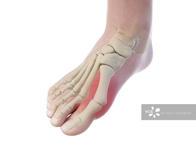 拇囊炎插画图片素材