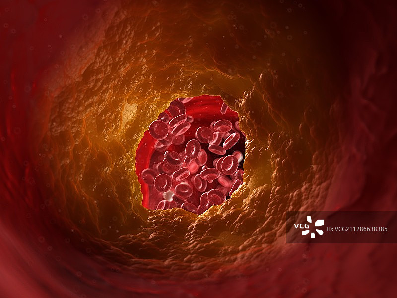 动脉阻塞插画图片素材