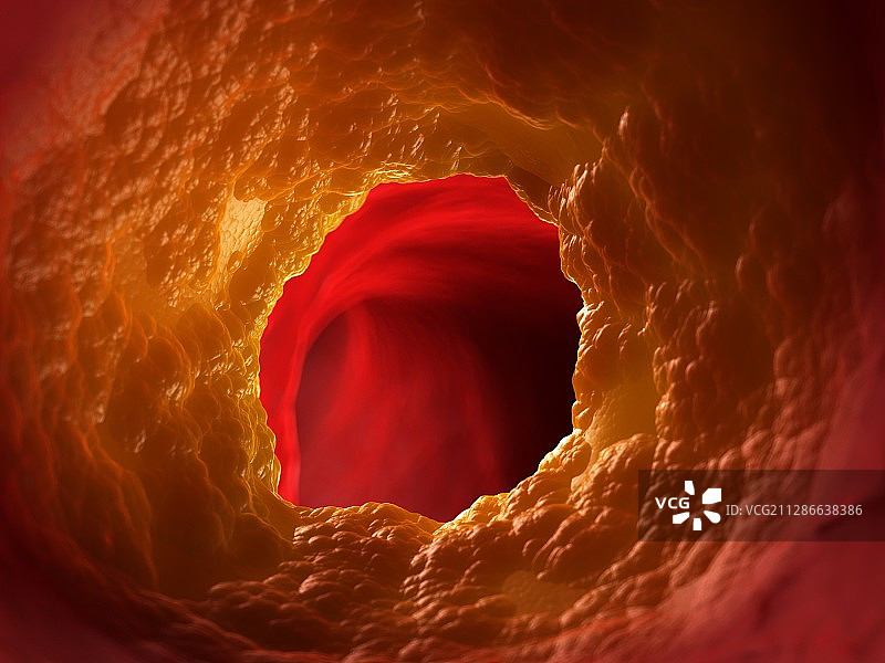 动脉阻塞插画图片素材