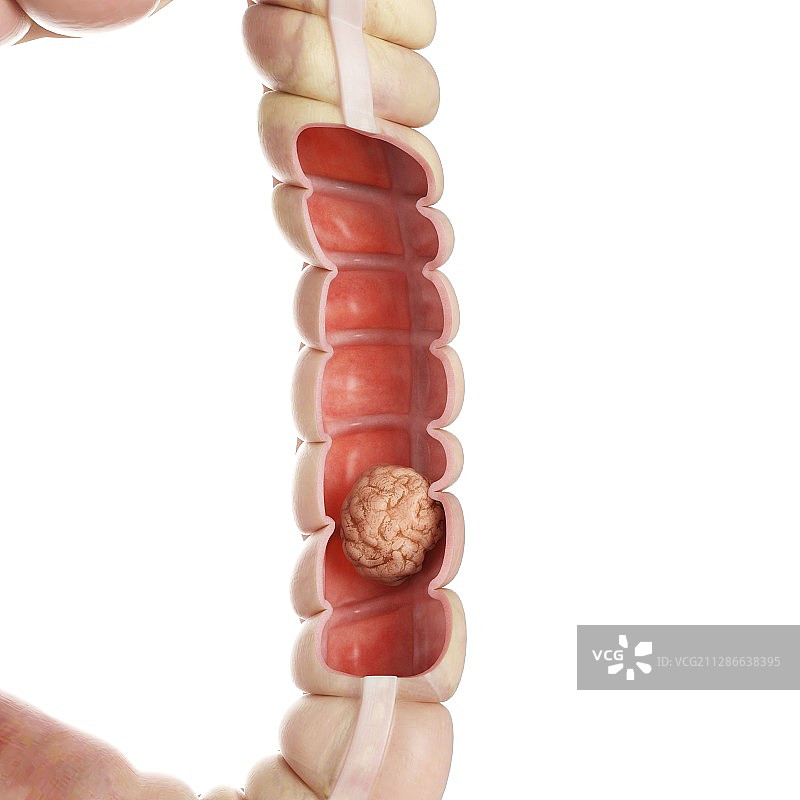 结肠肿瘤插画图片素材
