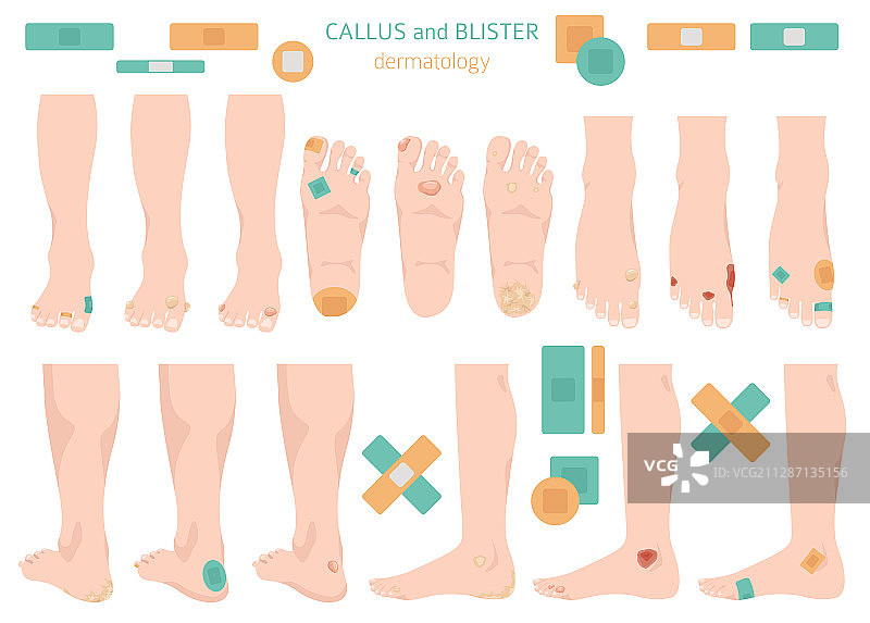 手脚上的老茧、鸡眼和水泡图片素材