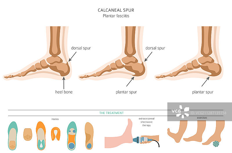 跟骨骨刺足底筋膜炎医疗套装图片素材