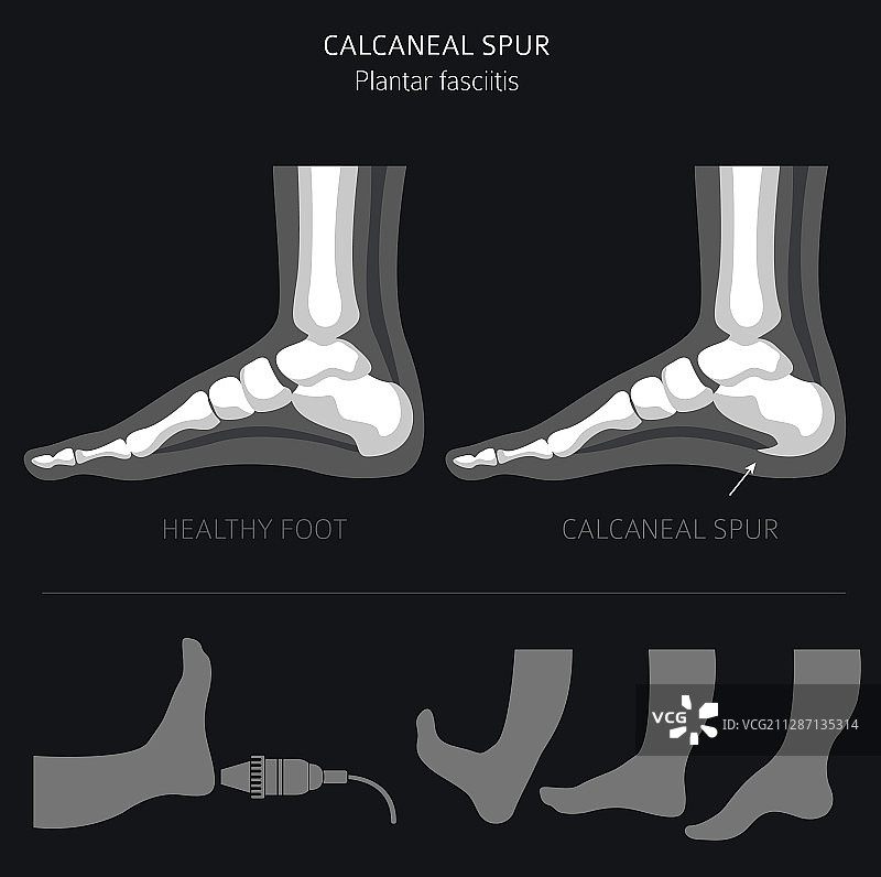 跟骨骨刺足底筋膜炎医疗套装图片素材