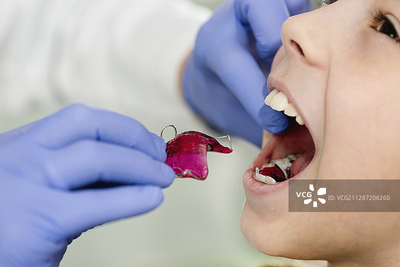 牙齿矫正器图片素材