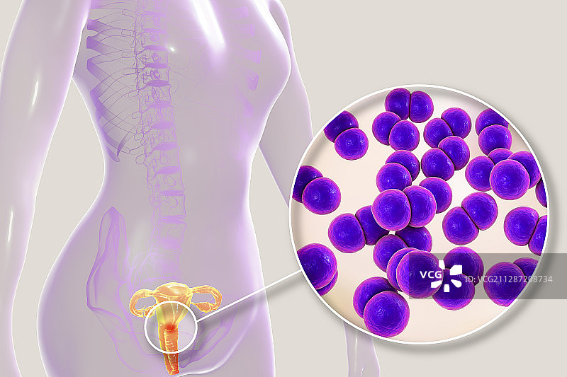 女性淋病感染图示图片素材