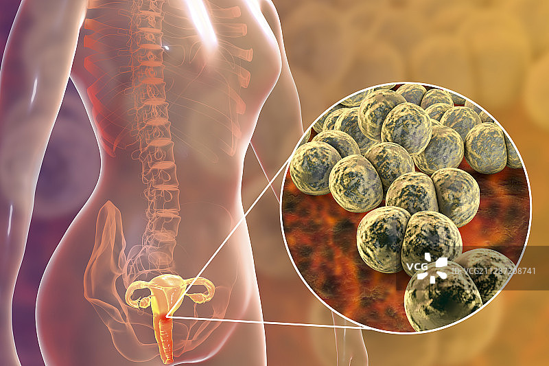 女性淋病感染图示图片素材