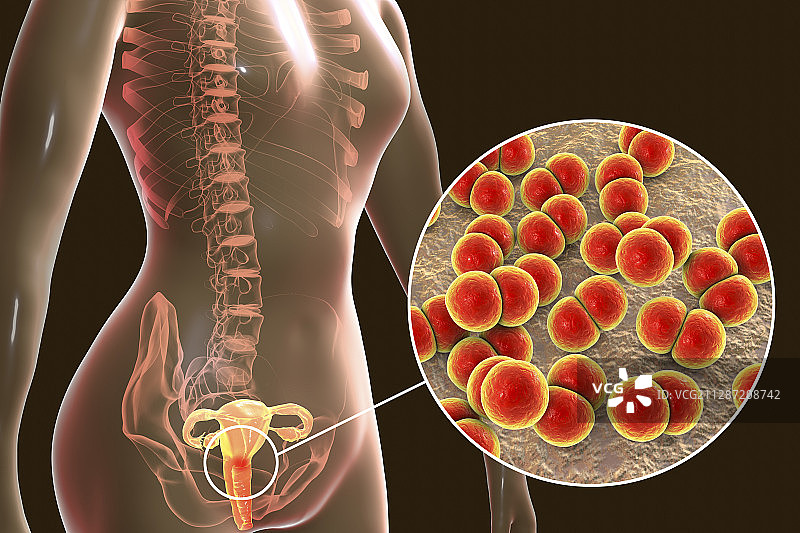 女性淋病感染图示图片素材
