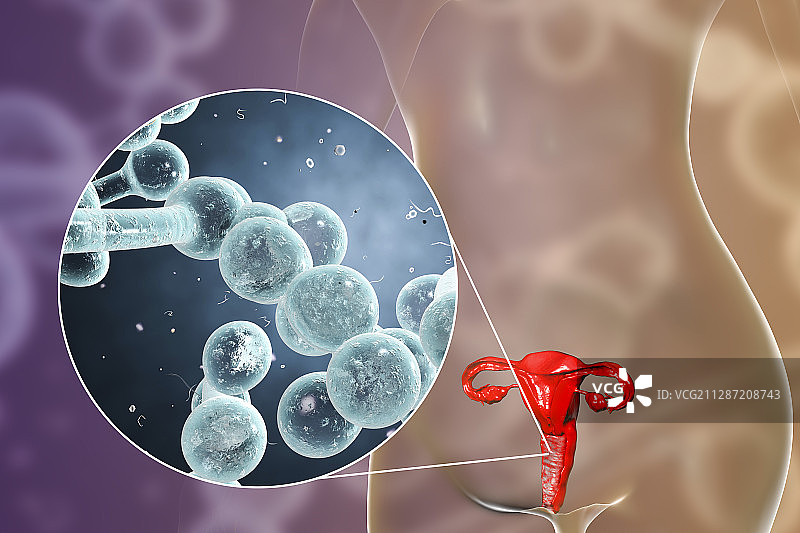 女性白色念珠菌感染插图图片素材