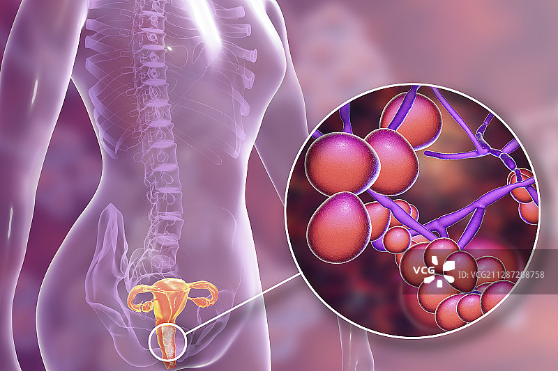 女性白色念珠菌感染插图图片素材