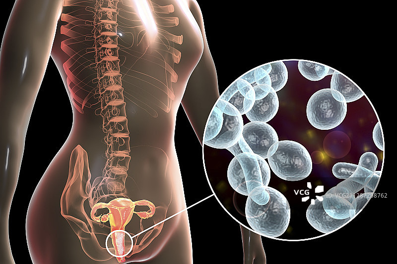 女性白色念珠菌感染插图图片素材