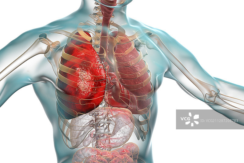 肺炎插图图片素材