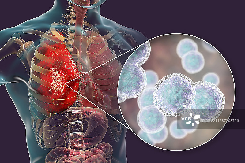 由卡他莫拉菌引起的肺炎插图图片素材