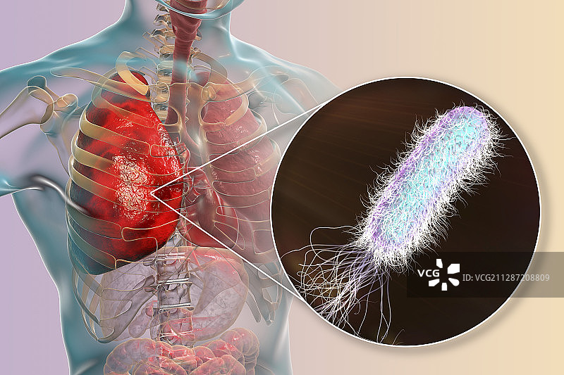 由卡他莫拉菌引起的肺炎插图图片素材
