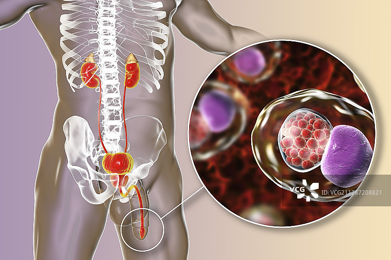 衣原体感染插图图片素材