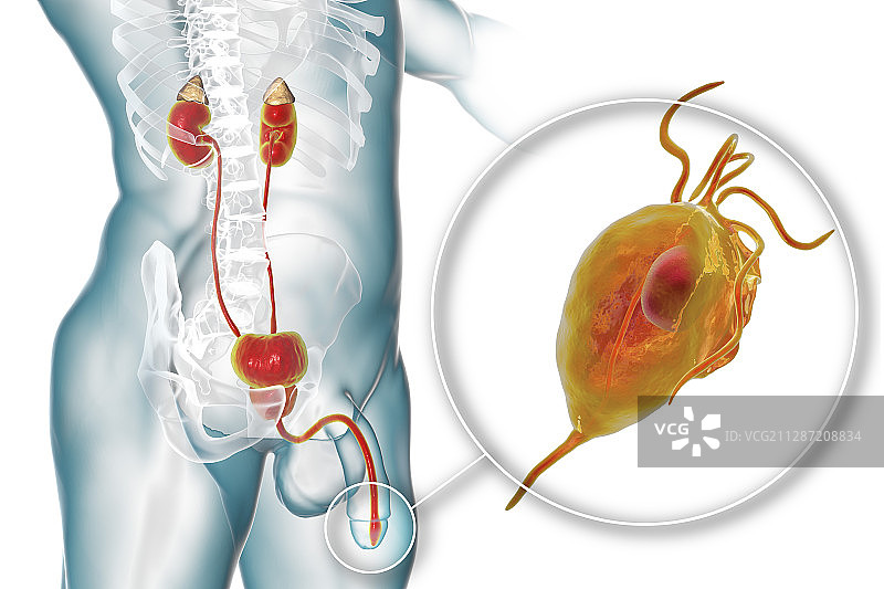滴虫病，图示图片素材