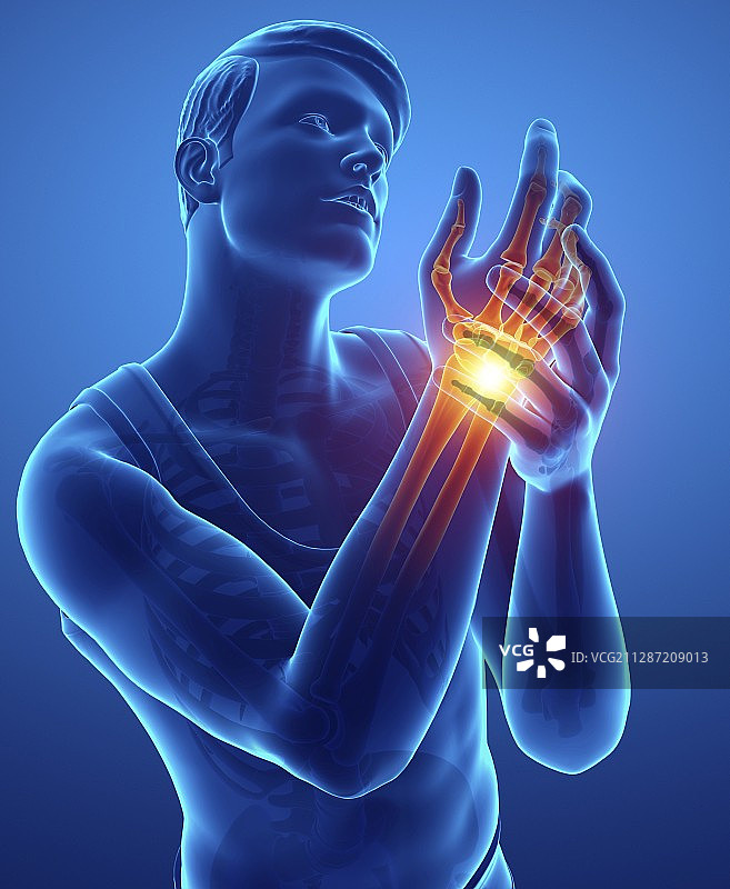 手腕疼痛的男人，插图图片素材