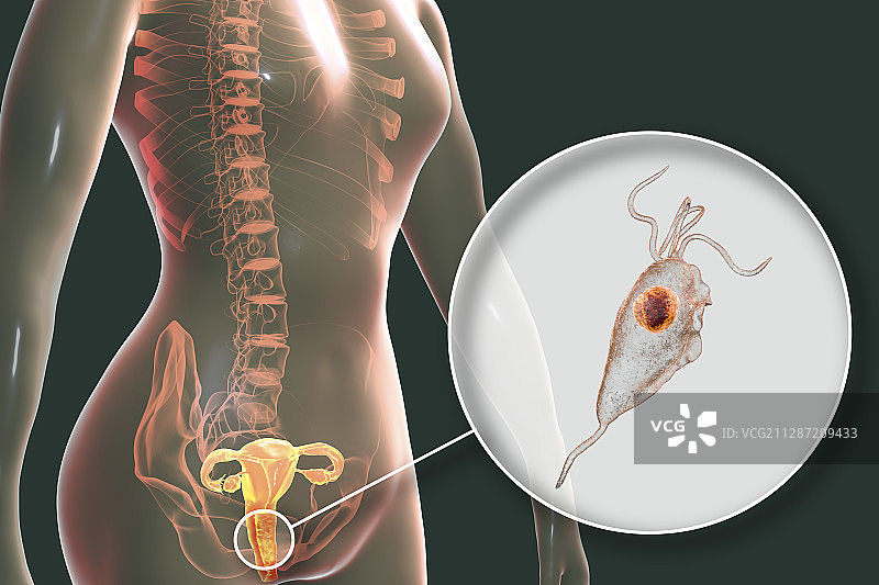 滴虫病，图示图片素材