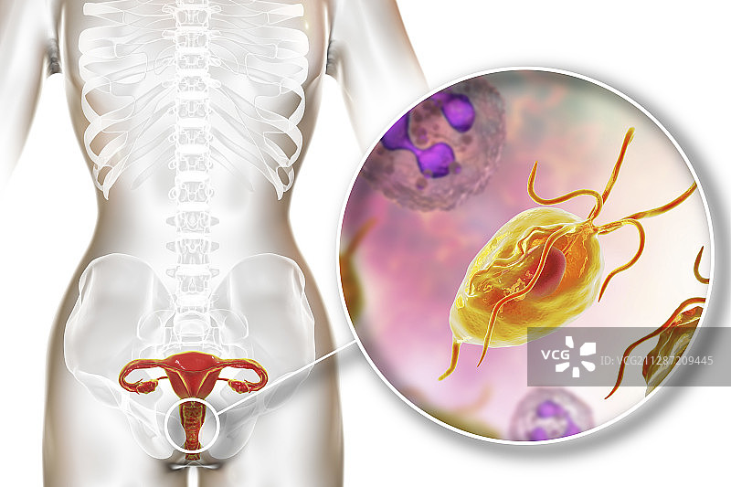 滴虫病，图示图片素材