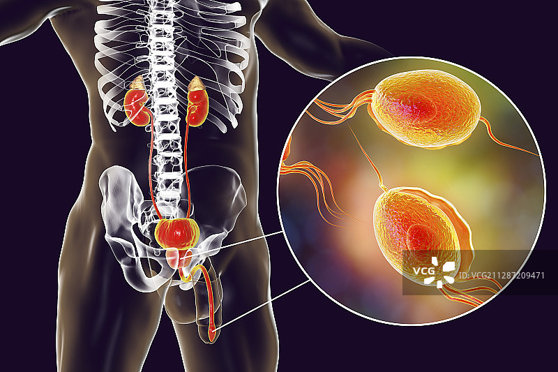 滴虫病，图示图片素材