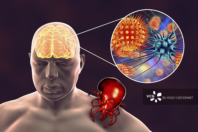 蜱传脑炎插图图片素材