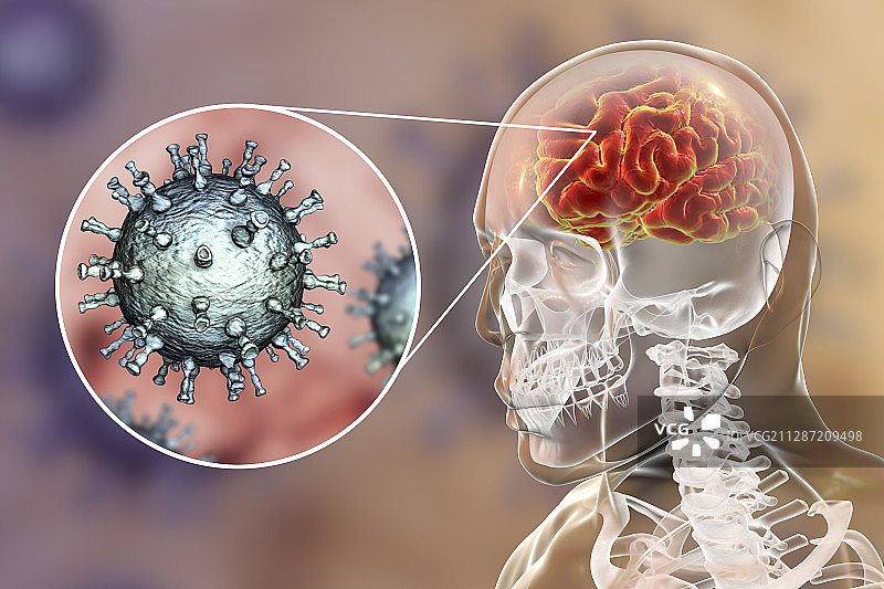 由水痘带状疱疹病毒引起的脑炎，图示图片素材