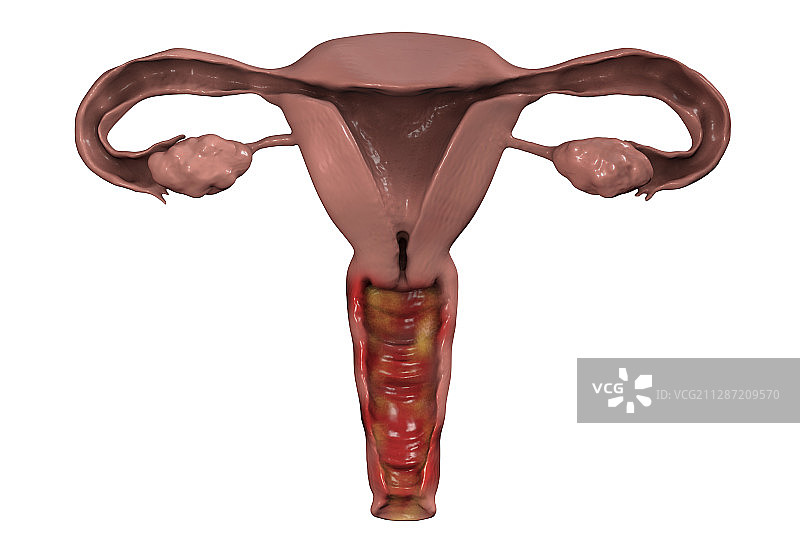 阴道炎插图图片素材
