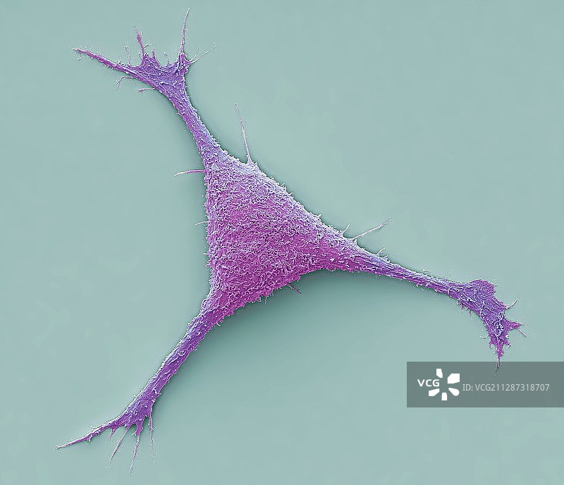 乳腺癌细胞扫描电镜图图片素材