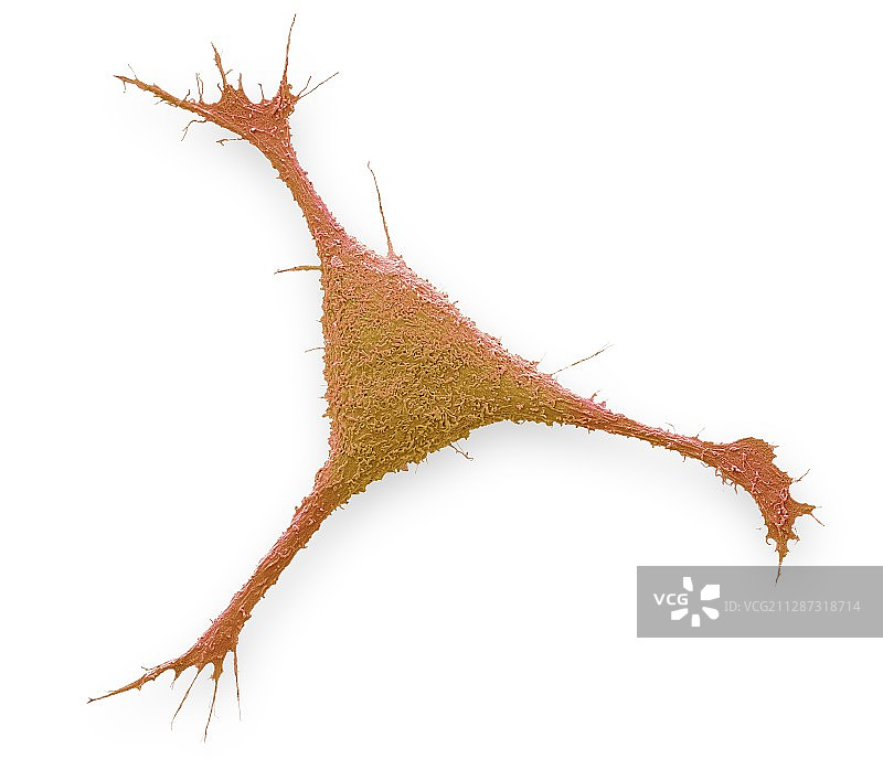 乳腺癌细胞扫描电镜图图片素材