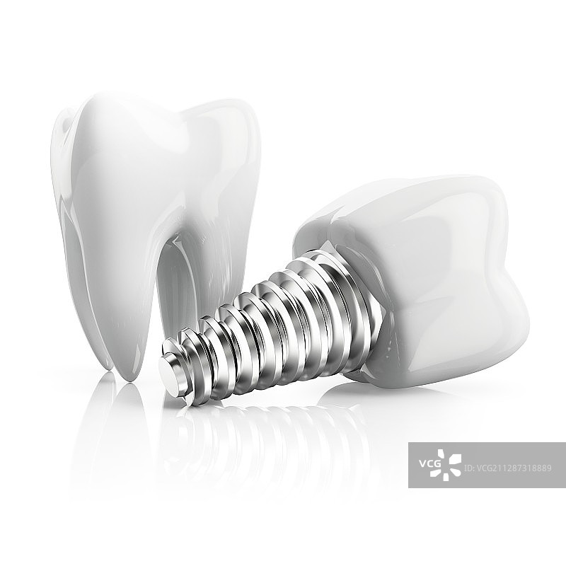 牙齿植入插图图片素材