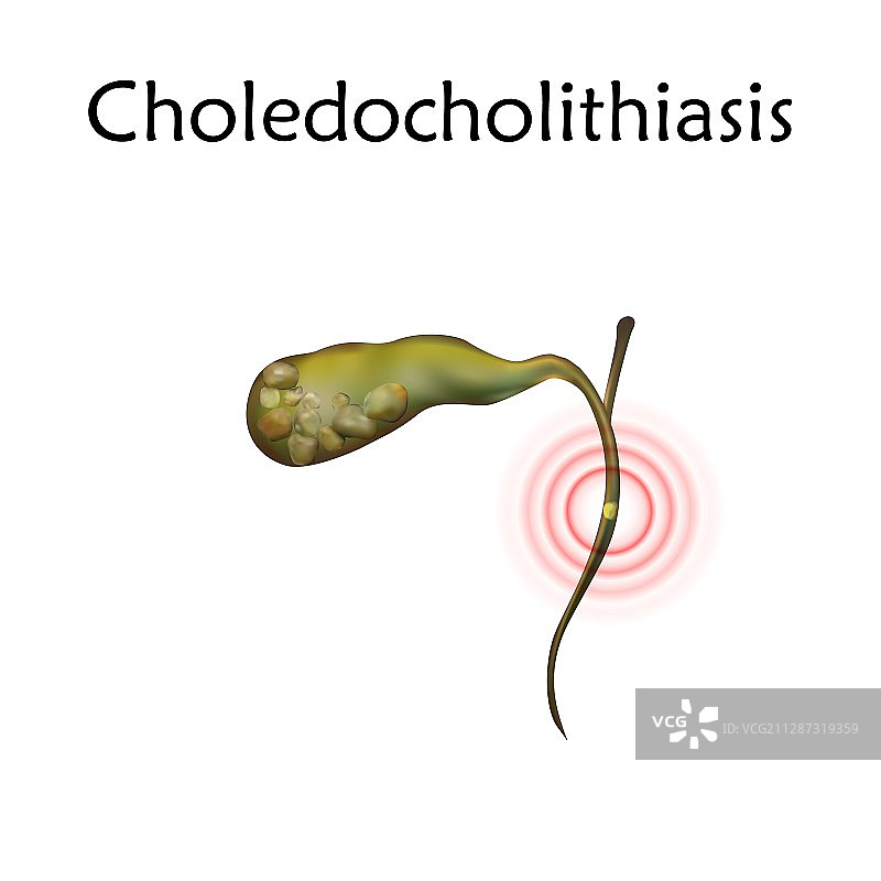 胆总管结石，图示图片素材