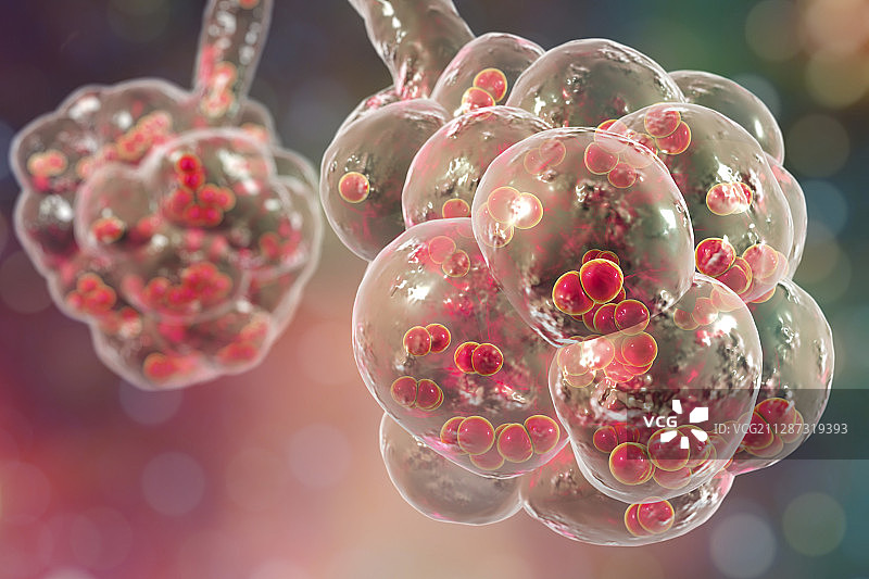 肺炎球菌性肺炎插图图片素材