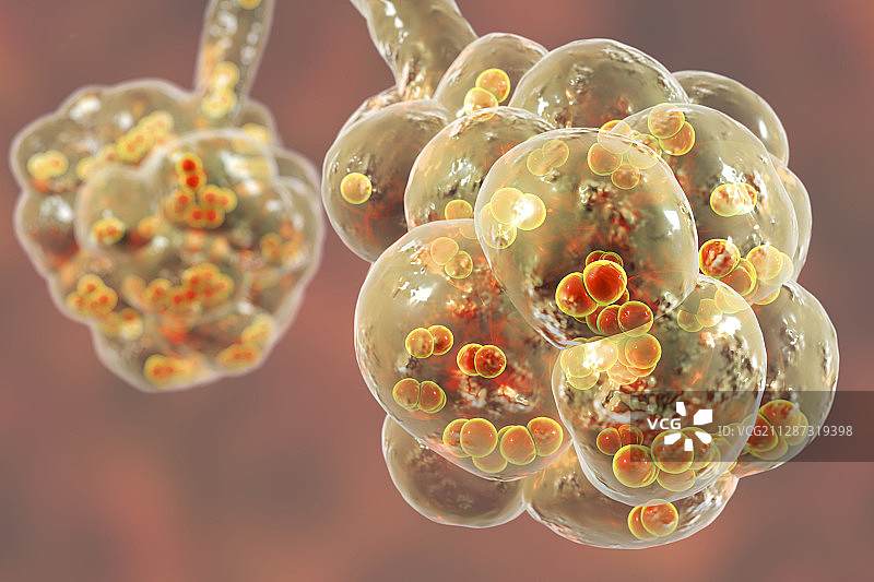 肺炎球菌性肺炎插图图片素材