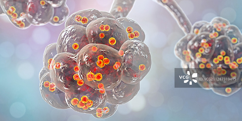 葡萄球菌肺炎，图示图片素材