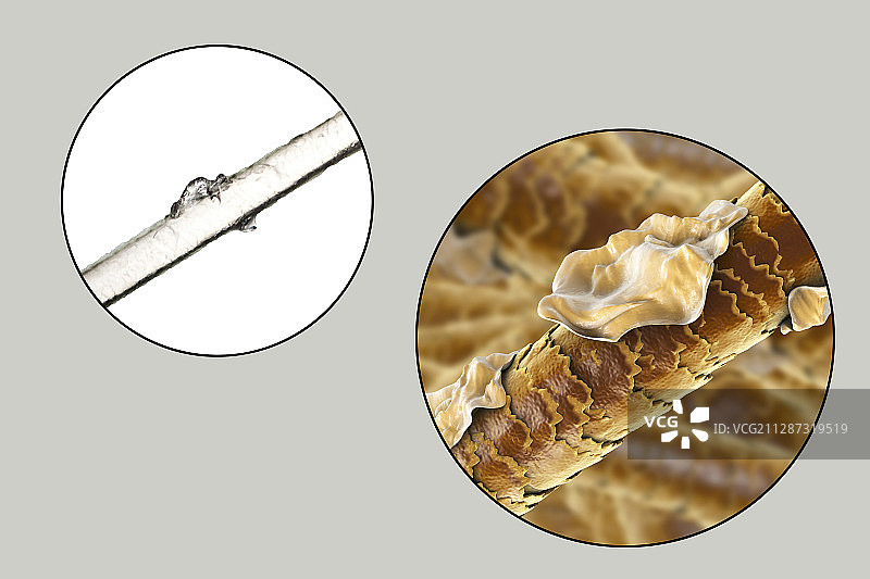 有头皮屑的人类头发，图示和显微照片图片素材