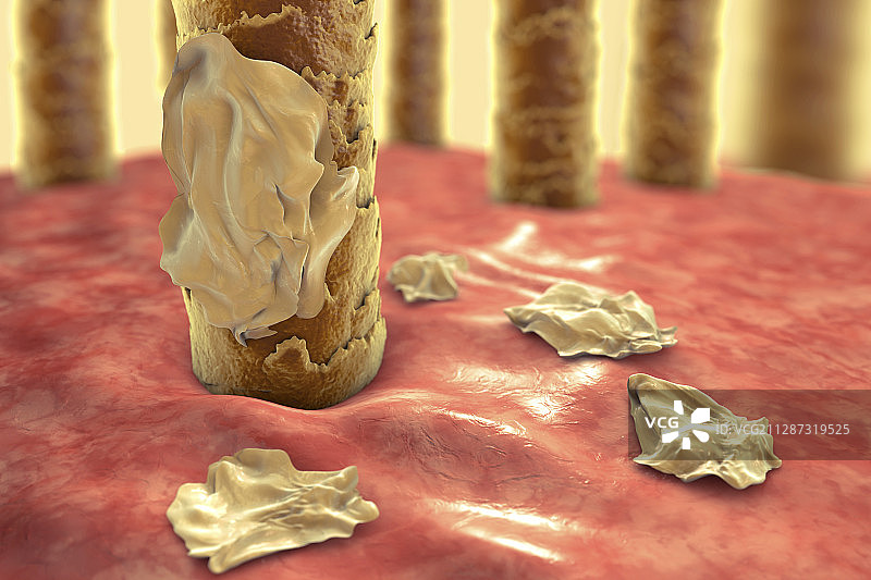 头皮屑图示图片素材