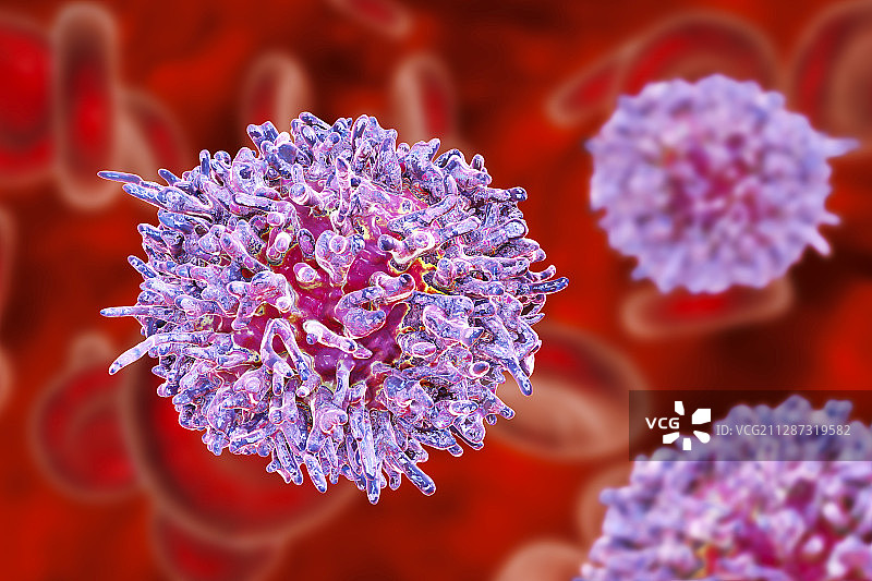 毛细胞白血病中的淋巴细胞，图示图片素材