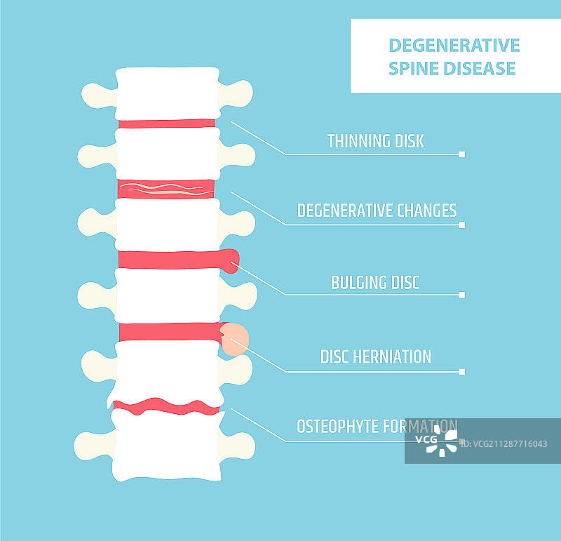 退行性椎间盘疾病脊柱关节炎图片素材
