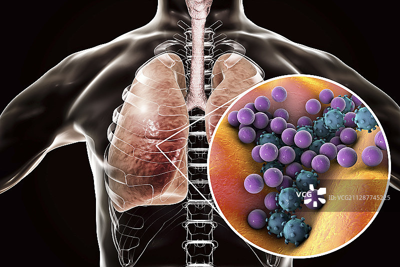 肺炎概念图图片素材
