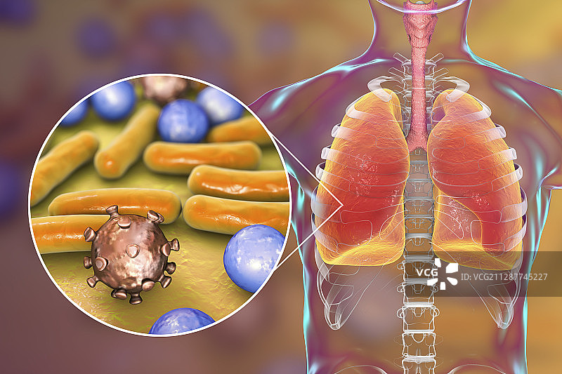 肺炎概念图图片素材