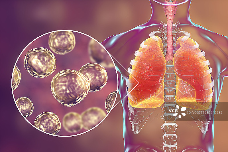 肺 blastomyces 菌病概念图图片素材