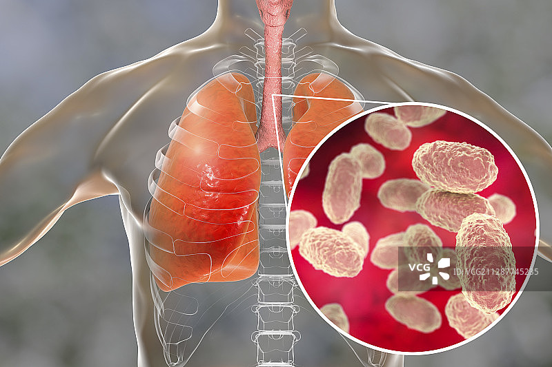 百日咳概念图图片素材