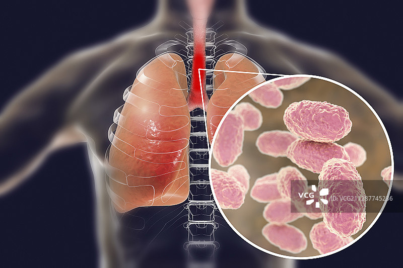百日咳概念图图片素材