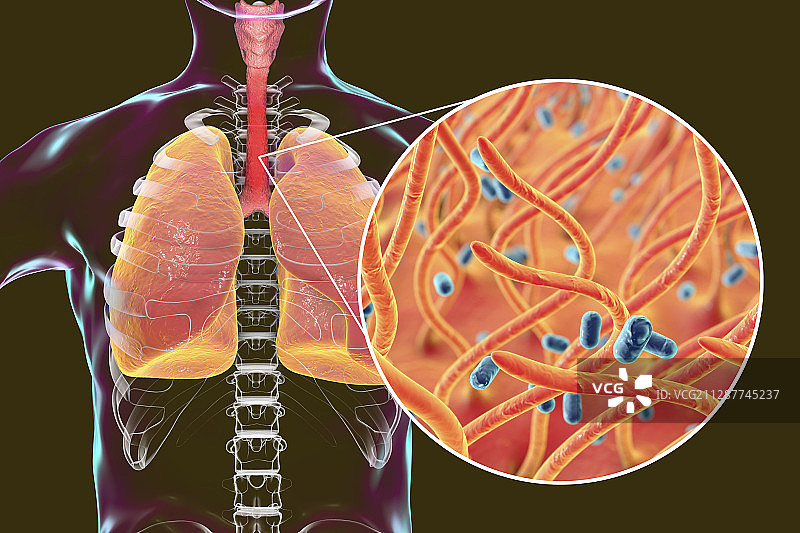 百日咳概念图图片素材