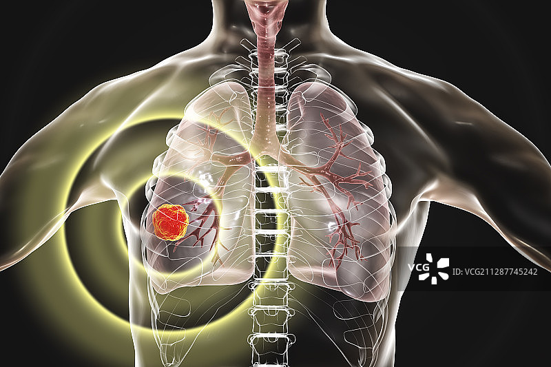 肺癌的治疗和预防概念插图图片素材