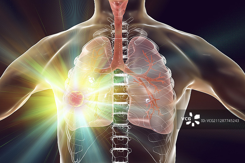 肺癌的治疗和预防概念插图图片素材