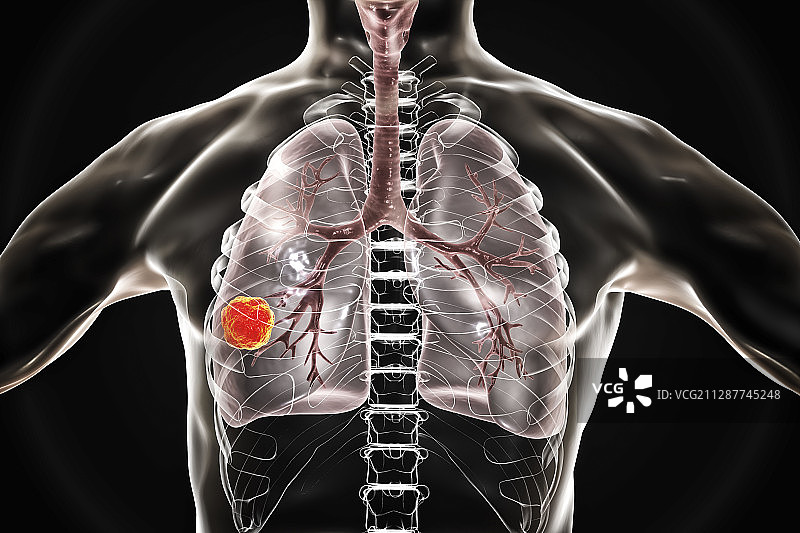 肺癌插图图片素材